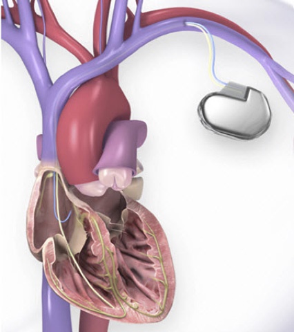 Temporary Pacing Wire (TPW) placed in a heart